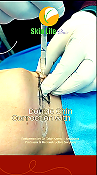 Chin Filler &amp; Under-Eye Filler